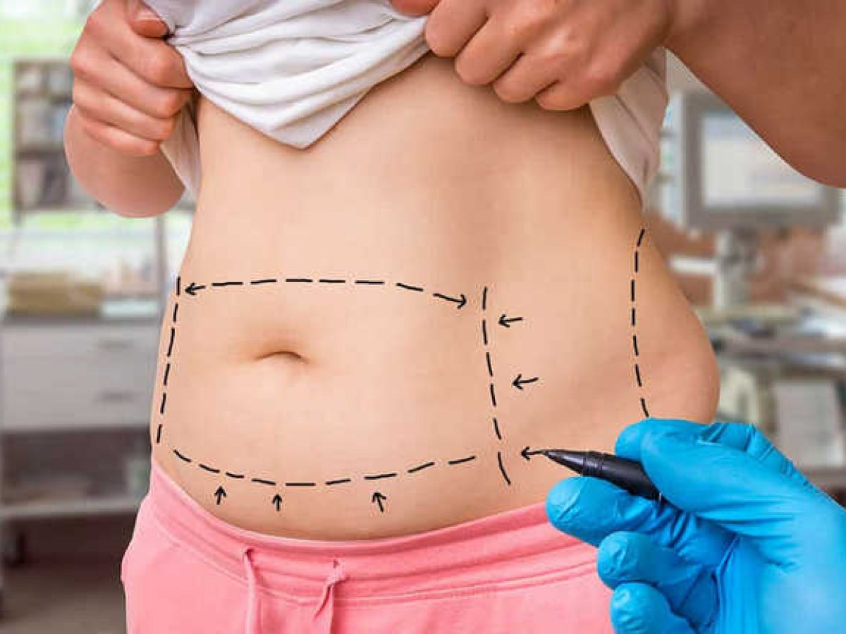 Tummy Tuck